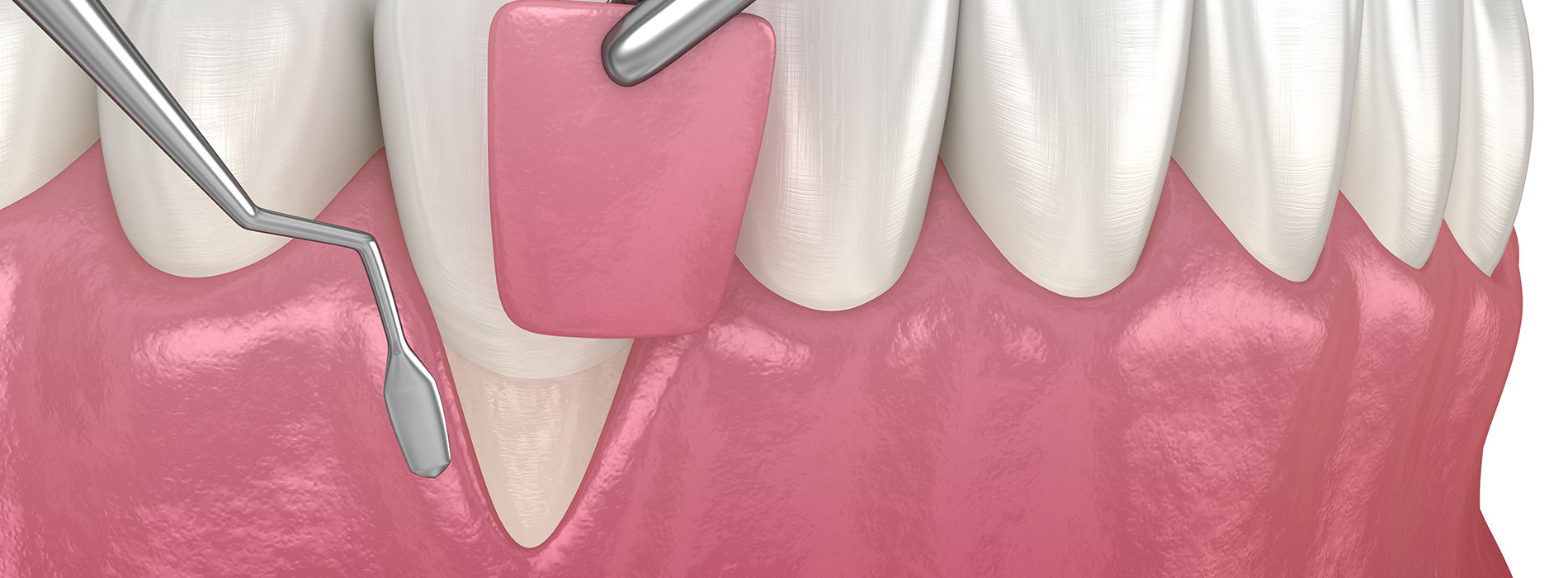 Soft Tissue Management in Bayshore