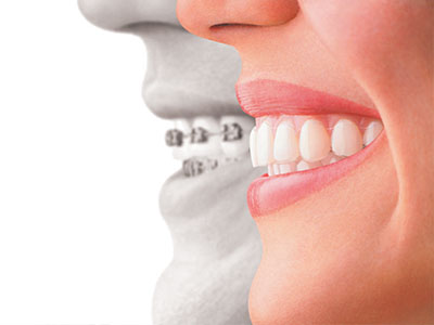 Advanced Dental Care | Sports Mouthguards, Implant Restorations and Soft Tissue Management