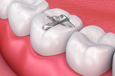 Advanced Dental Care | Implant Restorations, Root Canals and Sports Mouthguards