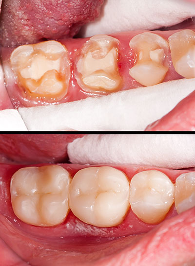 Advanced Dental Care | Soft Tissue Management, Implant Restorations and Periodontal Treatment