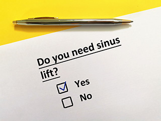 Sinus Lift in Patchogue